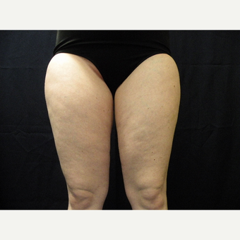 18-24 year old woman treated with CoolSculpting before 3680260