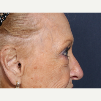 75 and up year old woman treated with Eyelid Surgery (view 2 of 2) before 3710616