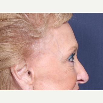 75 and up year old woman treated with Eyelid Surgery (view 2 of 2) after 3710616