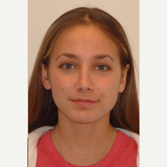 18-24 year old woman treated with Ear Surgery after 3259152