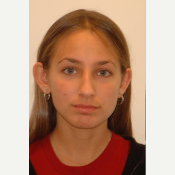 18-24 year old woman treated with Ear Surgery before 3259152
