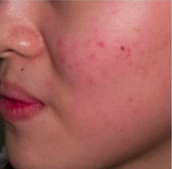 18-24 year old woman treated with Pulsed Dye Laser before 2119791