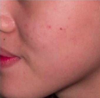 18-24 year old woman treated with Pulsed Dye Laser after 2119791