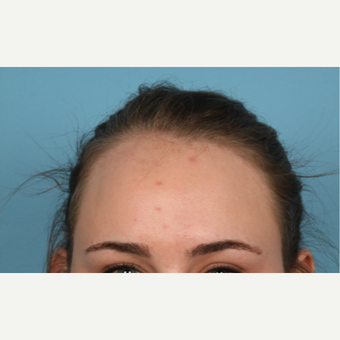 18-24 year old woman treated with Hairline Lowering Forehead Reduction before 3588523