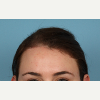 18-24 year old woman treated with Hairline Lowering Forehead Reduction after 3588523