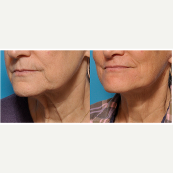 Lower Face and Neck Lift with Full Laser Resurfacing Around the Mouth before 3793549