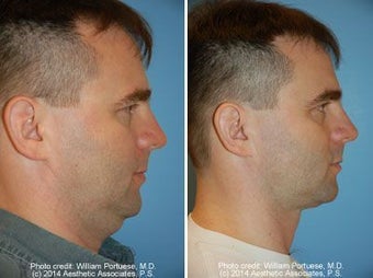 Neck Liposuction before 212300