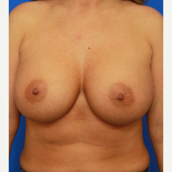 36- year old woman treated with Breast Implant Revision after 3168177