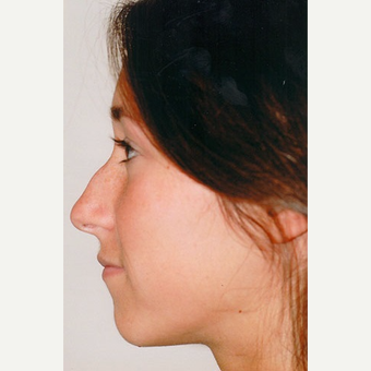 18-24 year old woman treated with Rhinoplasty before 3406209