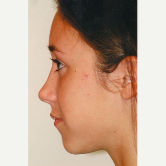18-24 year old woman treated with Rhinoplasty after 3406209