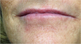 45-54 year old woman treated with Lip Augmentation after 3494045
