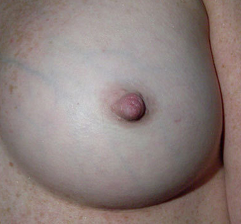 Inverted Nipple Correction after 1232999
