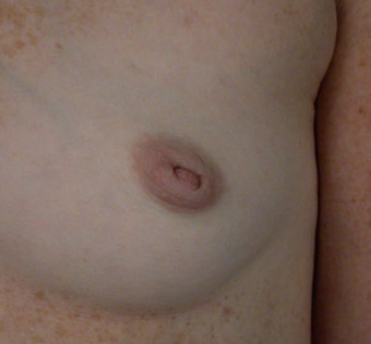 Inverted Nipple Correction before 1232999
