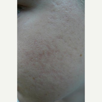 Fractional CO2 for scars before 2096006