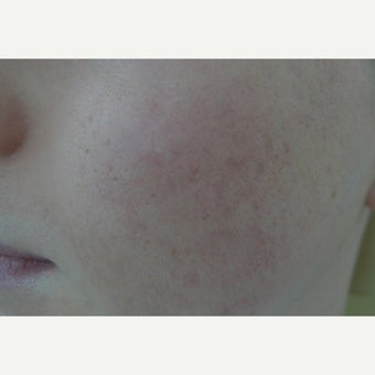 Fractional CO2 for scars after 2096006