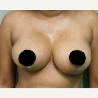 35-44 year old woman treated with Breast Reduction after 3458551