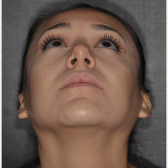 18-24 year old woman treated with Buccal Fat Removal 1 year post-op after 3708677