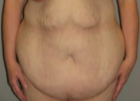 39 year old woman treated with Tummy Tuck before 3287353