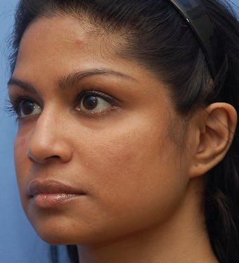 Cheek Dermafillers,Facial Dermafillers,Cheek Enhancement,Eye Dermafillers before 273734