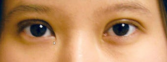 blepharoplasty after 1065148