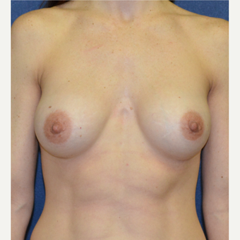 35-44 year old woman treated with Breast Augmentation after 3140103