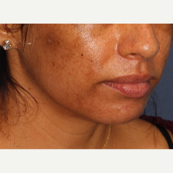 25-34 year old woman treated with Laser Treatment before 3230357