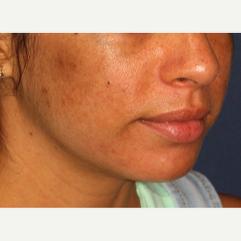 25-34 year old woman treated with Laser Treatment after 3230357