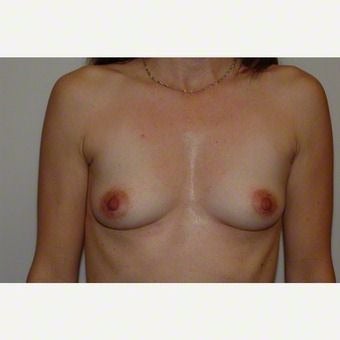 Breast Augmentation before 2259355