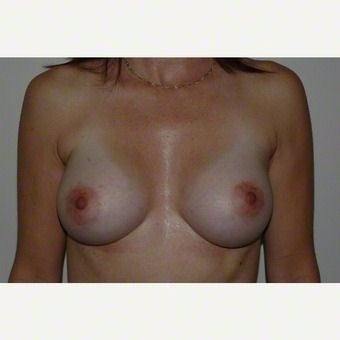 Breast Augmentation after 2259355