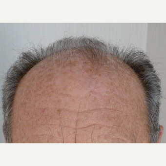 55-64 year old man treated with Hair Transplant before 3371863