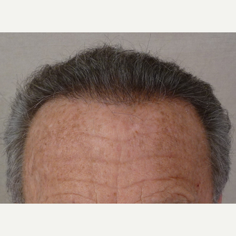 55-64 year old man treated with Hair Transplant after 3371863