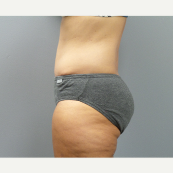 45-54 year old woman treated with Tummy Tuck after 3325394