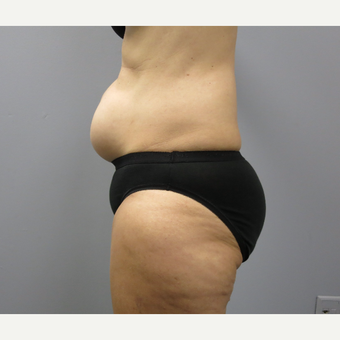 45-54 year old woman treated with Tummy Tuck before 3325394