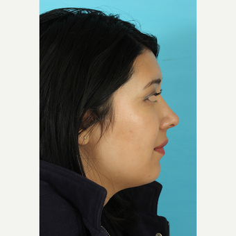 25-34 year old woman treated with Rhinoplasty after 3691303