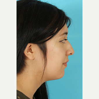 25-34 year old woman treated with Rhinoplasty before 3691303