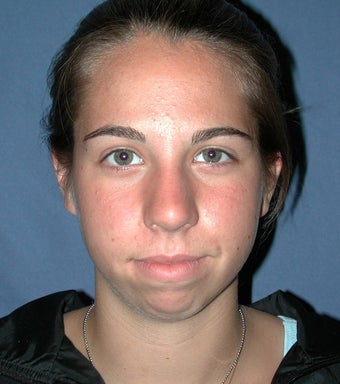 Chin Augmentation 224634