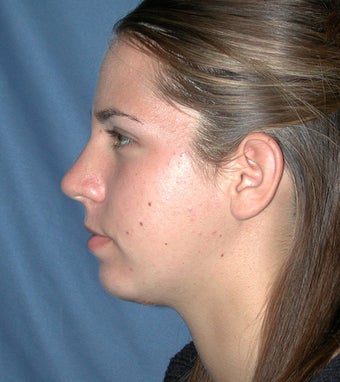 Chin Augmentation after 224634