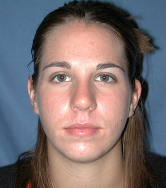 Chin Augmentation 224634