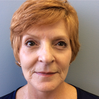 55-64 year old woman treated with SMAS facelift, bilateral lower blephroplasty & full face TCA Peel after 3075075
