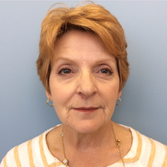 55-64 year old woman treated with SMAS facelift, bilateral lower blephroplasty & full face TCA Peel before 3075075