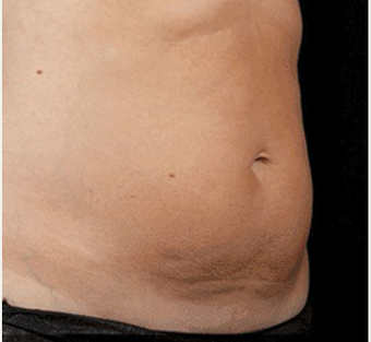 SculpSure Made with Smart Lipo Technology after 3698304