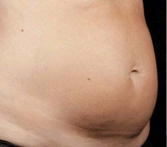 SculpSure Made with Smart Lipo Technology before 3698304