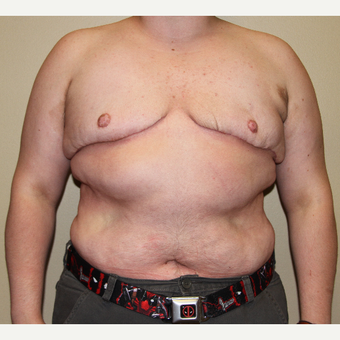 18-24 year old man treated with FTM Chest Masculinization Surgery after 3215338