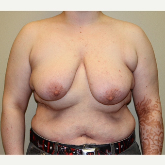 18-24 year old man treated with FTM Chest Masculinization Surgery before 3215338