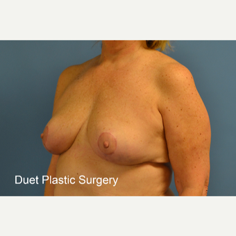 45-54 year old woman treated with Breast Lift after 3350274