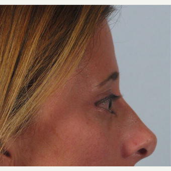 35-44 year old woman treated with Brow Lift after 3261203