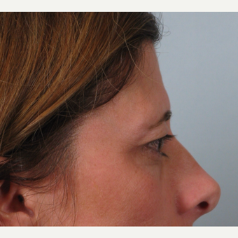 35-44 year old woman treated with Brow Lift before 3261203