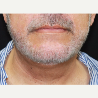 57 year old male treated with Kybella after 3026082