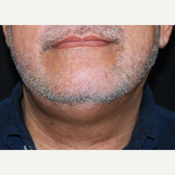 57 year old male treated with Kybella before 3026082