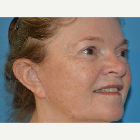 35-44 year old woman treated with Eyelid Surgery after 3065725